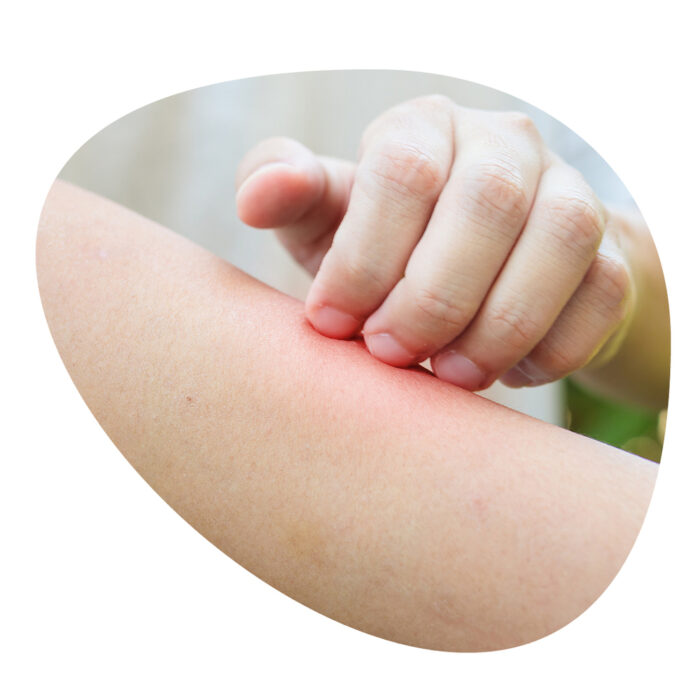 INSECT BITE - immagine 2